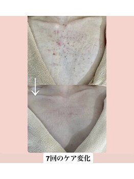 スキンハピネス(skinhappiness)/デコルテハーブピーリング