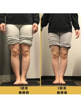 ベル/【40代会員様】O脚矯正の変化