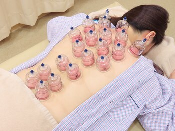 こころ鍼灸マッサージ院/カッピング(吸い玉療法)