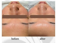 アン ビューティー(ann beauty)/施術1回【症例写真】