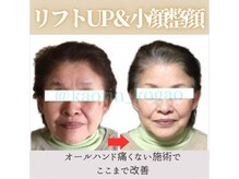 顔凛(カオリン)/60代女性の小顔矯正
