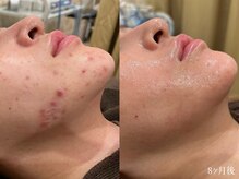 エピア 西尾店(Epia)/フェイスラインニキビ/20代女性