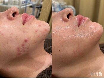 エピア 西尾店(Epia)/フェイスラインニキビ/20代女性