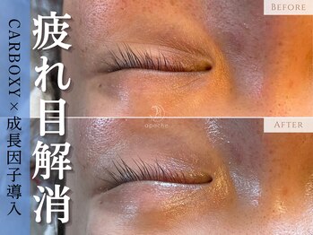 アポシェ(apoche)/目元ケア/疲れ目/シワ改善/ハリ