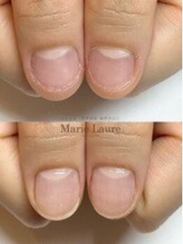 マリーロール 梅田店(Marie Laure)/自爪育成/深爪矯正/ネイルケア