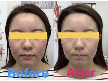 ふたば接骨院 豊橋/毛穴ケアにも効果あり◎