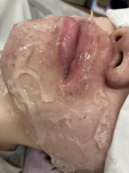 美容脱毛専門サロン エピラージュ 新宿店(Epilage)/黒いプツプツが抜けたヒゲ!