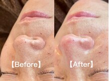 シアン(CYAN)/【毛穴】ビフォー/アフター