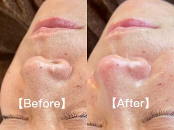 シアン(CYAN)/【毛穴】ビフォー/アフター