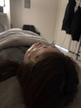 ラフテル鍼灸整骨院/目のクマに美容鍼がおすすめ♪