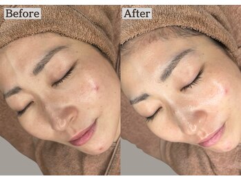 あすはれ/人気No.1☆剥けないピーリング