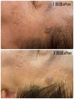 ムム(mumu)/長年のシミが薄く肌の水分量UP