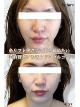 ルミライ(Lumirai)/小顔効果絶大の方続出中