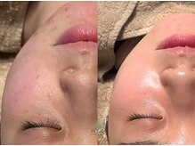 フラーブ(Flourb)/ハーブピーリング｜症例写真