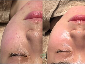 フラーブ(Flourb)/ハーブピーリング|症例写真