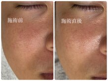 シェミー(CHEZ MEE)/【メンズ美容】毛穴/乾燥/赤ら顔