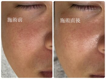 シェミー(CHEZ MEE)/【メンズ美容】毛穴/乾燥/赤ら顔