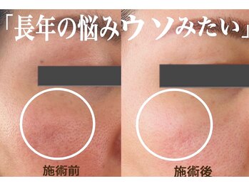 美的アヴェニール(美的.Avenir)の写真/《最高峰》針を使わず水光注入!
痛み、ダウンタイムなし◎