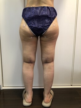 ソワン(Soin)/大腿脂肪¨吸の術後インディバ