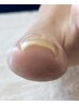 【foot巻き爪補正】巻き爪補正１爪＋プロのフットケア付き¥7,000◆￥7,700