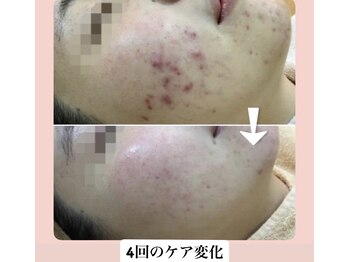 スキンハピネス(skinhappiness)/顔ハーブピーリング(ハード)