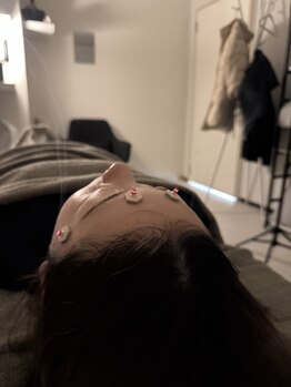 ラフテル鍼灸整骨院/美容医療は嫌な人は美容鍼が◎