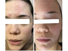 モカ 天王寺店(MOKA)/おでこニキビケア　ハーブ