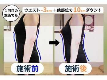 レシカ/1回でも変化が期待できる施術