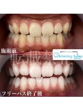 ホワイトニングサロン 福岡天神店/ホワイトニング