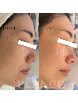プランス 恵比寿店(PLANCE)/ピカピカ、ツヤ肌に！