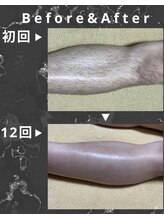 シック 南風原店(Chic)/20代　脚脱毛　6ヶ月経過写真