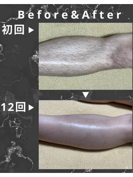 シック 南風原店(Chic)/20代　脚脱毛　6ヶ月経過写真