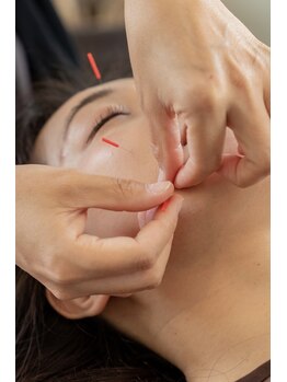 鍼灸ハリカラの写真/首肩こり・頭痛を鍼灸で改善｜深部から整えてスッキリ感も実感