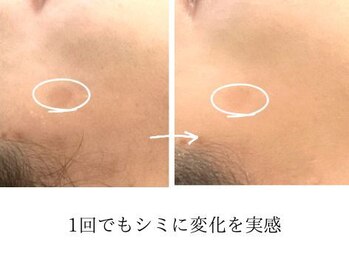 こもれび/１回のお手入れでの変化