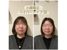 ビボーン ボディ(美bone body)/小顔矯正+ハイパーナイフ