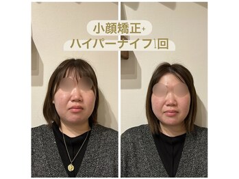 ビボーン ボディ(美bone body)/小顔矯正+ハイパーナイフ
