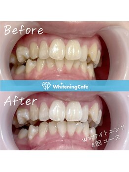 ホワイトニングカフェ 鹿児島中央駅前店(WhiteningCafe)の写真/【低価格/短時間/食事制限なし】歯科提携ホワイトニングで汚れリセット!歯に優しいジェル◎結果妥協なし!