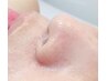【モニター募集特別価格】鼻の毛穴・顎のざらつき解決!毛穴エステ! （90分）