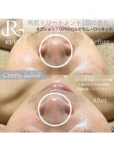 クレヴィー(Creviy)/陶肌トリートメント