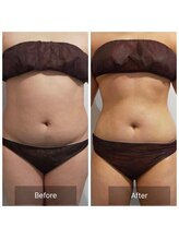 ビルーチェ(BELUCE)/脂肪冷却