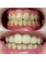 ワイズサロン(Y's salon)/ホワイトニング１回の症例です！