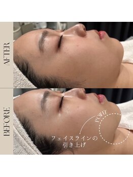 インフィニーズ(INFINEEZ)/カスタマイズ120分小顔矯正20代