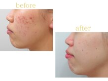 オリス 名古屋店(oliss)/リセットプログラムbefore/after