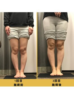 ベル/【30代会員様】O脚矯正の変化