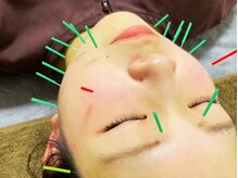 けん鍼きゅう整骨院の雰囲気（美容鍼でシワ・たるみの改善◎女性限定です◇）