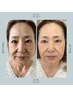 【医師監修】細胞レベルの再生美容ExolLift  チケット又は2回目以降の方
