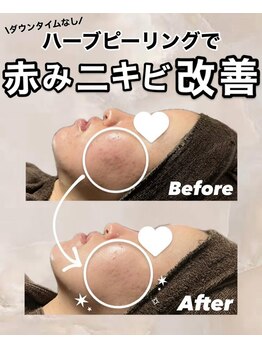 ビレボ マエバシ(BEREVO maebashi)/Before After