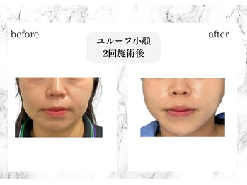 トキ(TOKI)/ユルーフ小顔リフト 2回施術