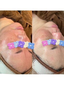 オーノ(Ohno)/人気NO.1マツヤニ×クレイ