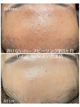 ルタンリッシュ さいたま店(Lutan Riche)/陶肌トリートメント　肌荒れ